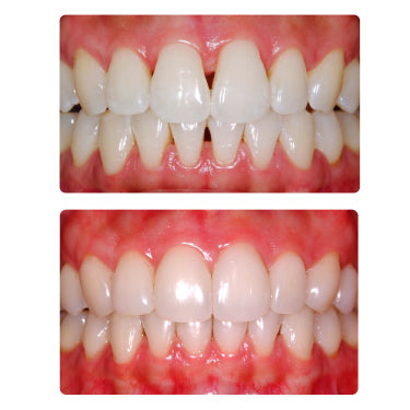 Load image into Gallery viewer, 2-Day Bioclear Program dental CE course with lecture and hands-on training for restorative dentists.