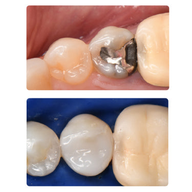 Load image into Gallery viewer, 2-Day Bioclear Program dental CE course with lecture and hands-on training for restorative dentists.