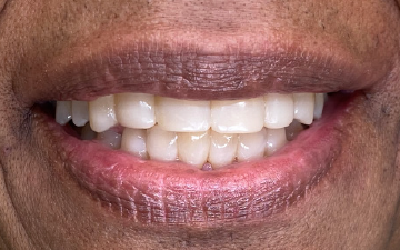 Load image into Gallery viewer, Same-Day Rejuvenation: Injection Molding 360° Composite Veneers