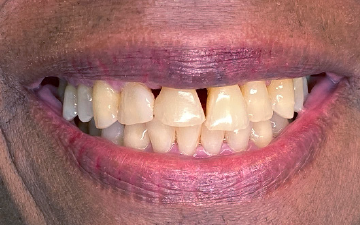 Load image into Gallery viewer, Same-Day Rejuvenation: Injection Molding 360° Composite Veneers