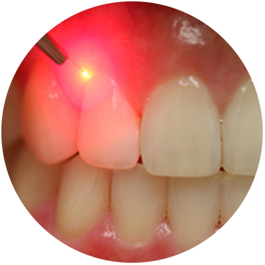 Soft Tissue Diode Lasers
