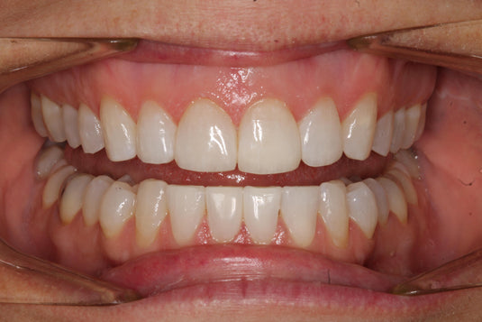 Modern Aesthetic Dentistry:  From Digital Planning to Advanced Composite Excellence (06-12)