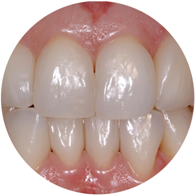 Anterior Matrix Solutions
