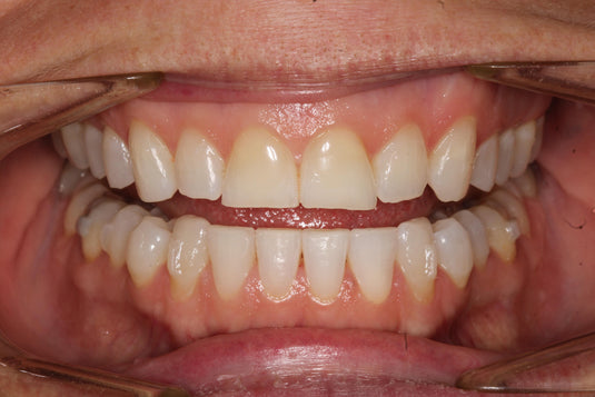 Modern Aesthetic Dentistry:  From Digital Planning to Advanced Composite Excellence (06-12)