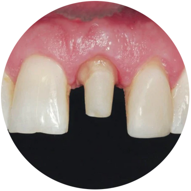 Fiber Posts - A Simple Protocol for Clinical Success