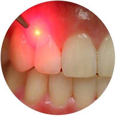 Soft Tissue Diode Lasers