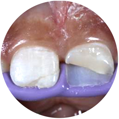 Universal Esthetic Composite